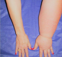 Knee pain