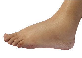 Acupuncture